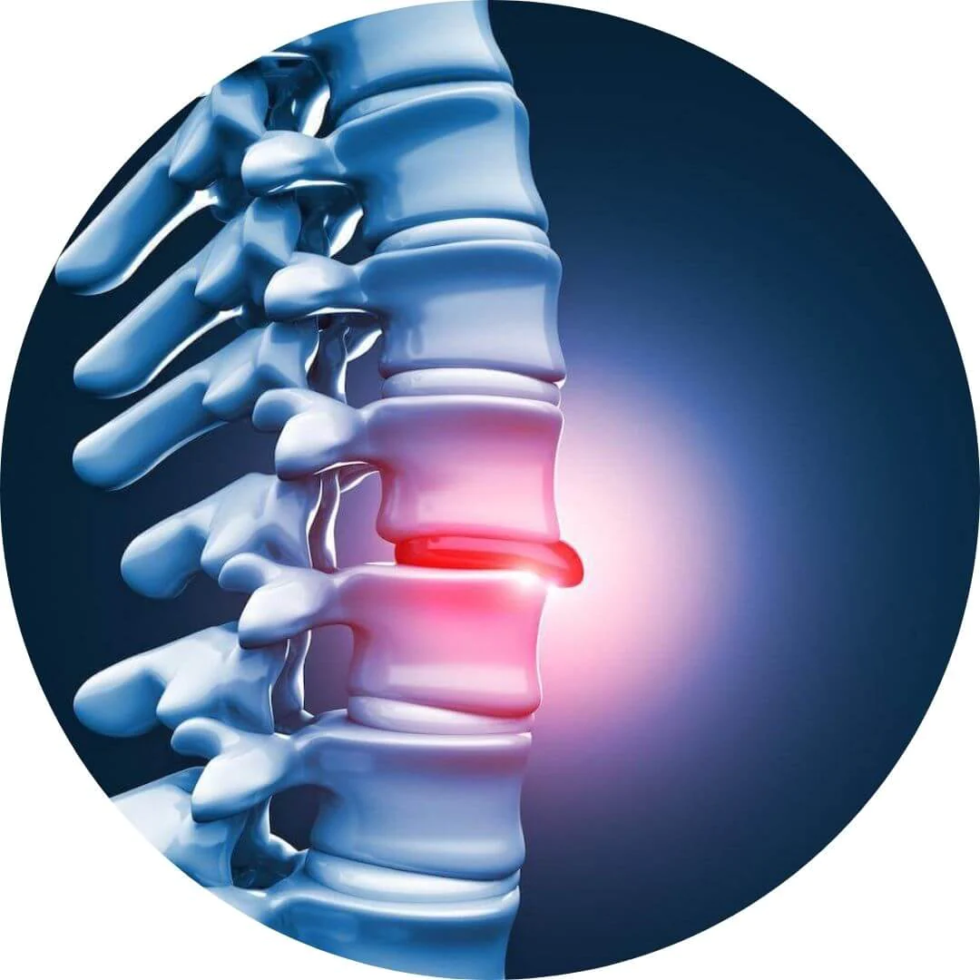 pf56e656398herniateddiscc-1653401716130-1.webp pf56e656398herniateddiscc-1653401716130-1.webp